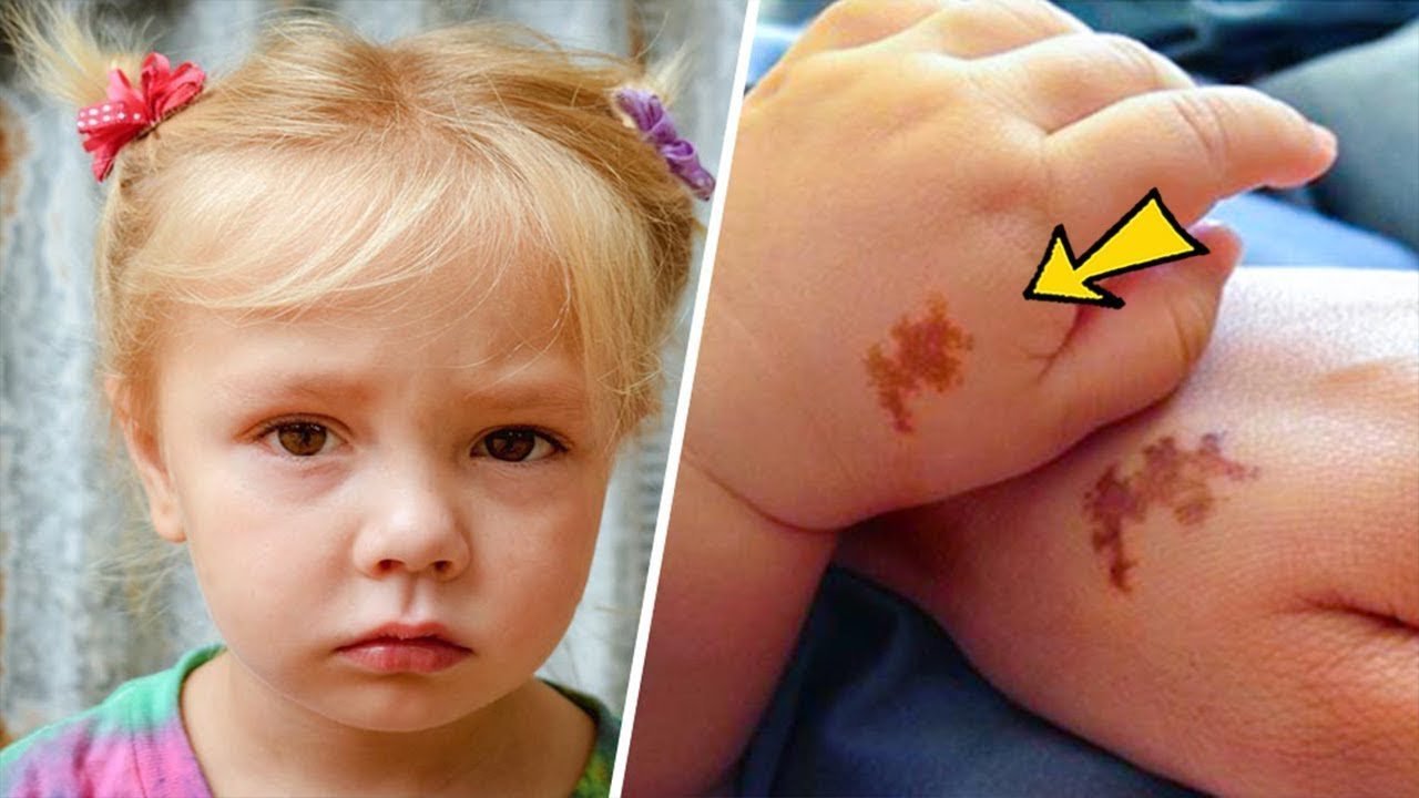 Mom adopts girl with same birthmark as her’s, doing a test she was shocked